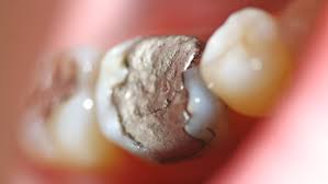 amalgam