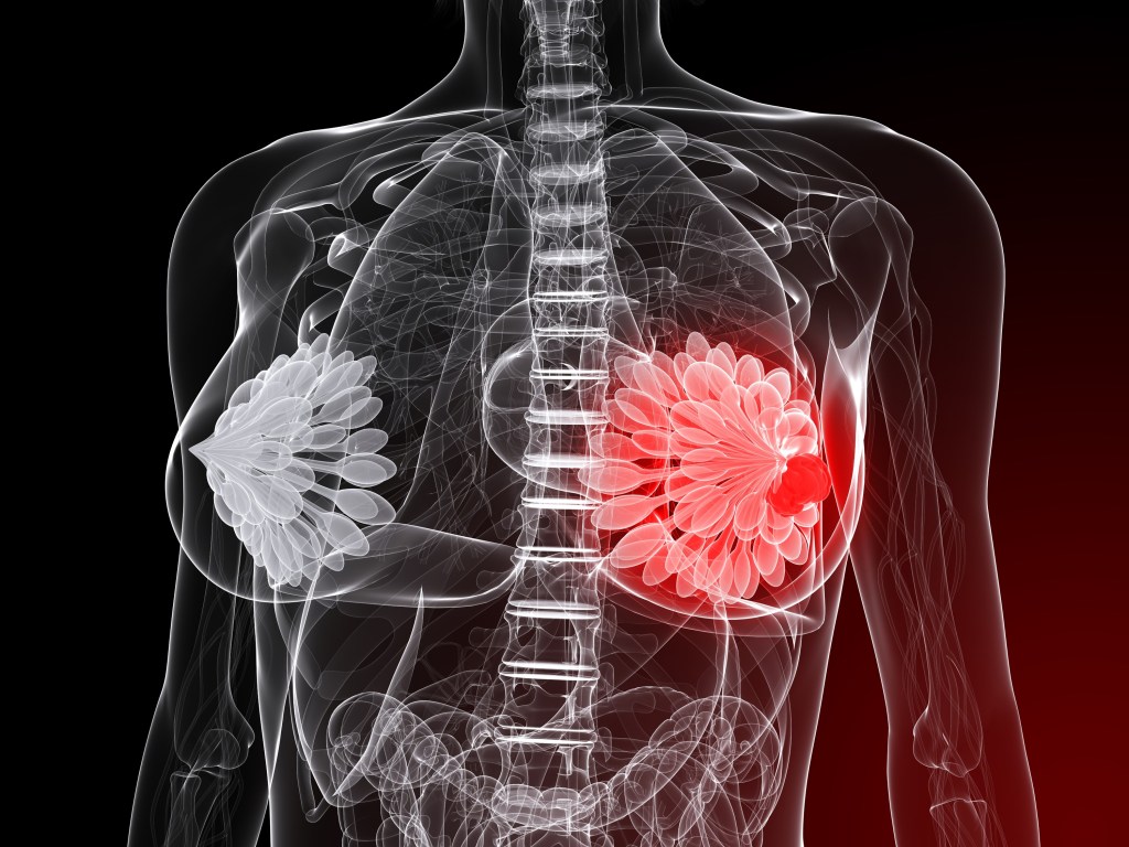 Hladina vitamínu D môže priamo súvisieť (nielen) s rakovinou&nbsp;prsníka
