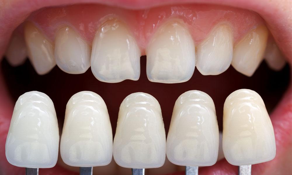 Je tu zubná katastrófa a ani nevieme, že je tu a týka sa&nbsp;nás!